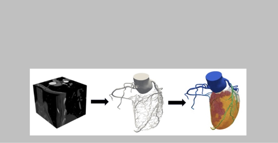 Cardiac digital twin model created from medical image data showing coronary arteries and simulation of blood flow into heart muscle. Credit: Charles Taylor, Oden Institute, The University of Texas at Austin